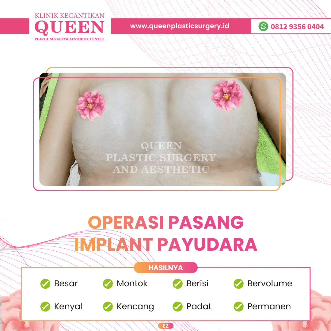 Hasil Breast Implant Queen Plastic Surgery, foto 9