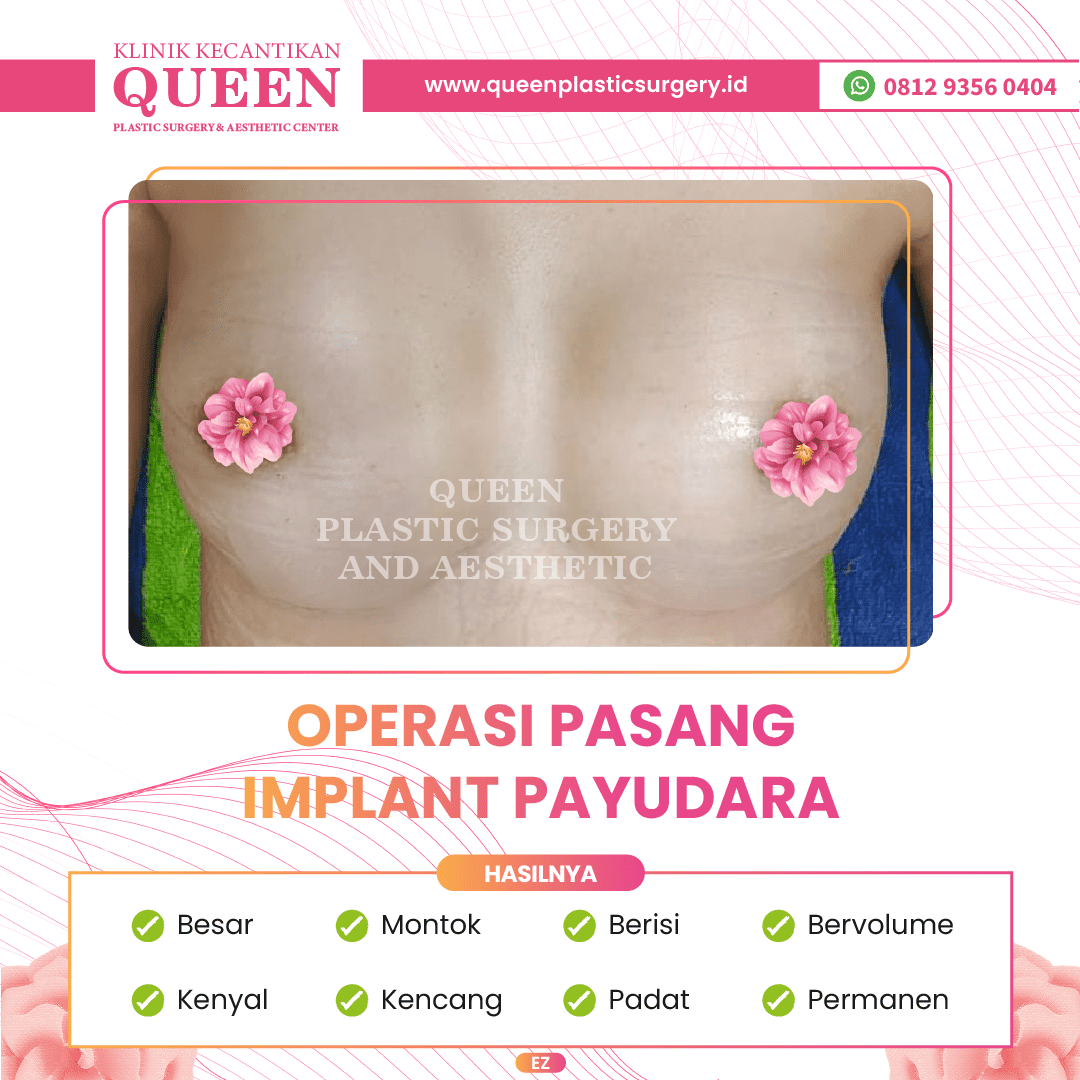 Hasil Breast Implant Queen Plastic Surgery, foto 10