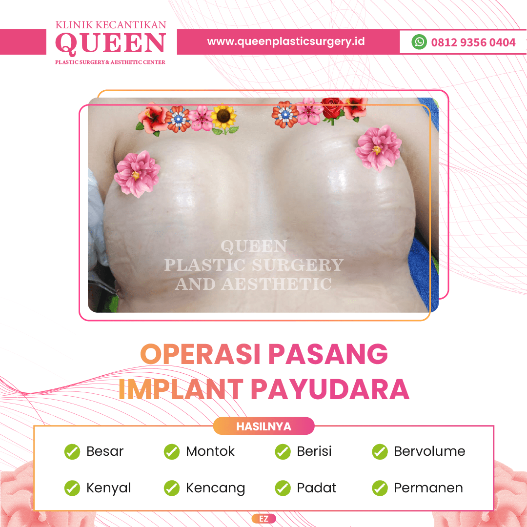 Hasil Breast Implant Queen Plastic Surgery, foto 11