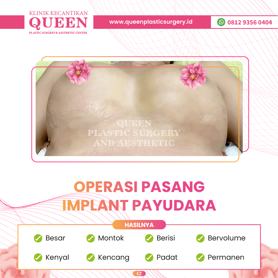 Hasil Breast Implant Queen Plastic Surgery, foto 12