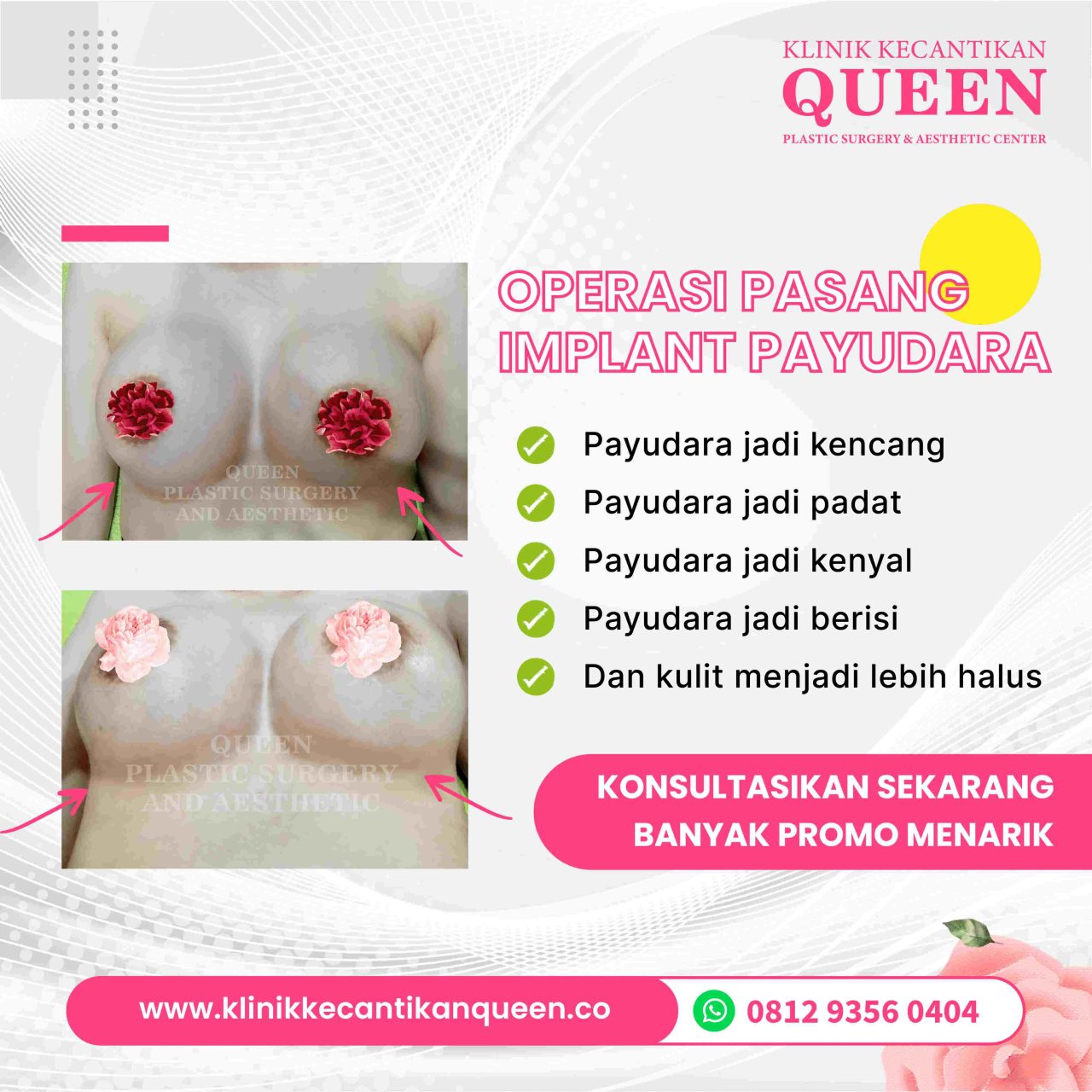 Hasil Breast Implant Queen Plastic Surgery, foto 3
