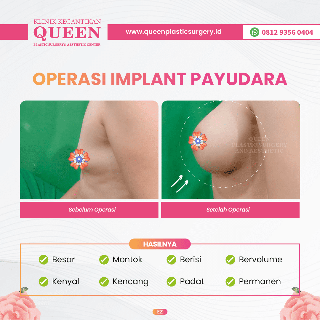 Hasil Breast Implant Queen Plastic Surgery, foto 4