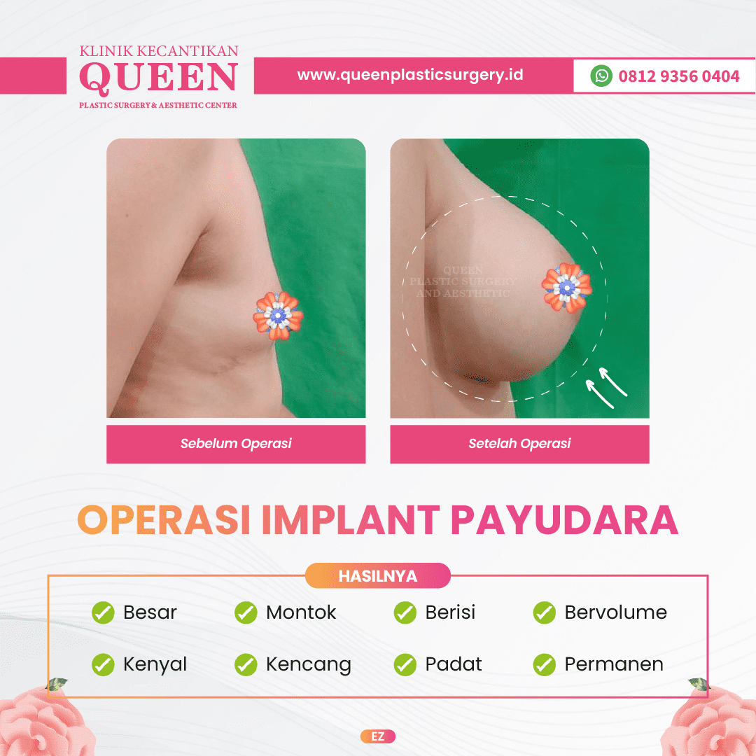 Hasil Breast Implant Queen Plastic Surgery, foto 2