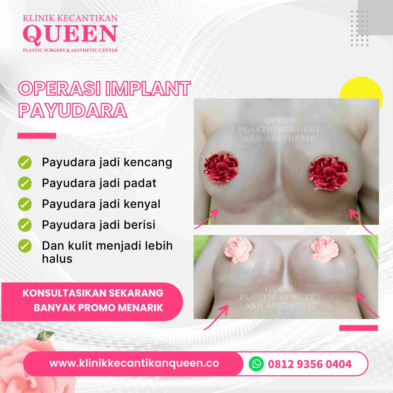 Hasil Breast Implant Queen Plastic Surgery, foto 99