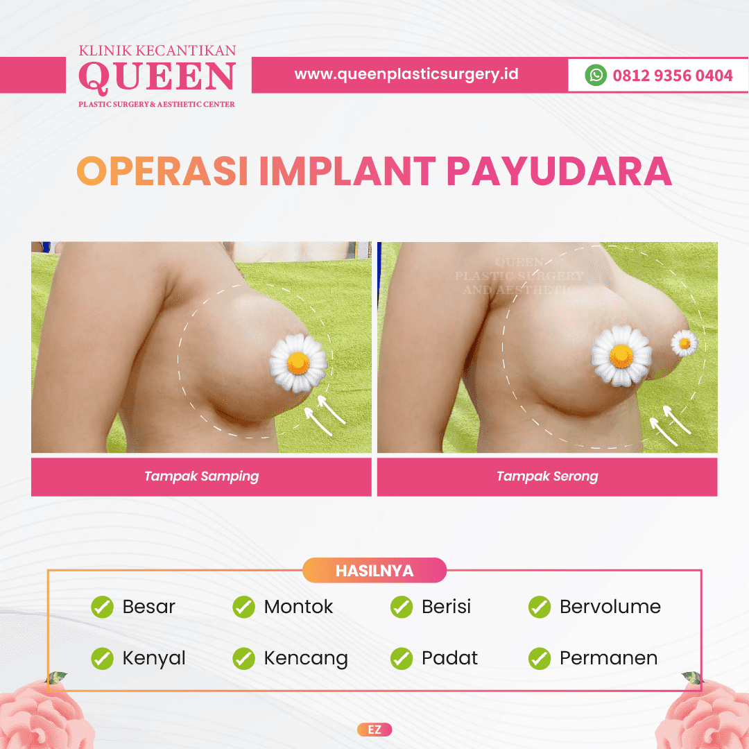 Hasil Breast Implant Queen Plastic Surgery, foto 100