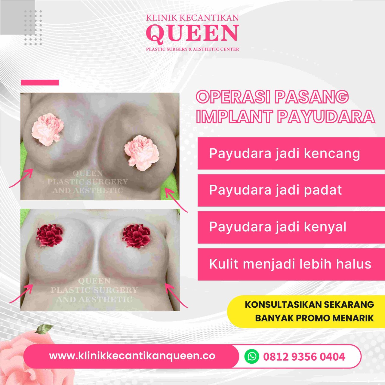 Hasil Breast Implant Queen Plastic Surgery, foto 97