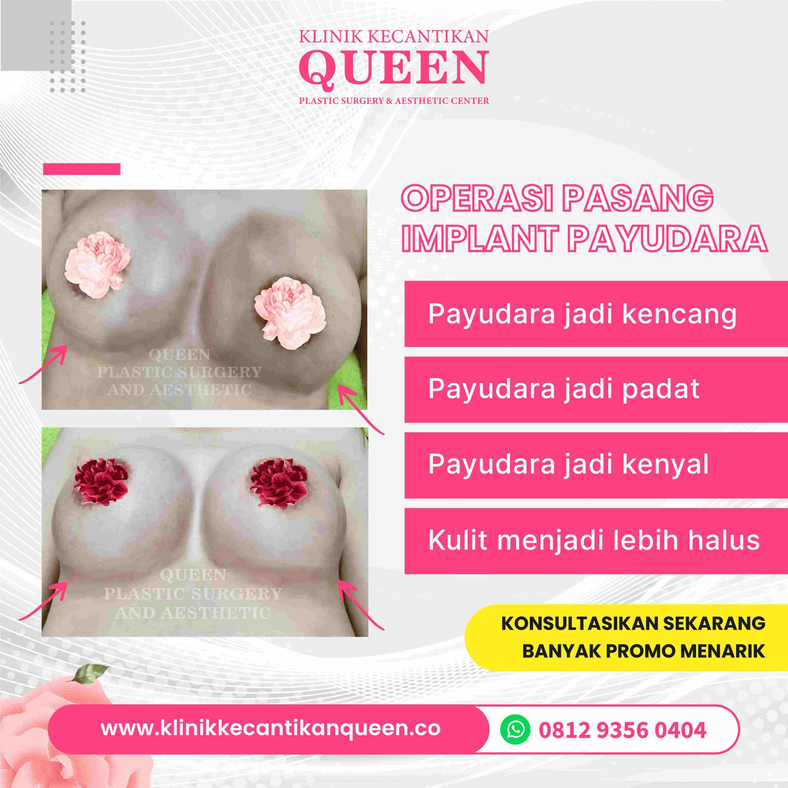 Ingin Payudara Lebih Besar? Revisi Augmentasi Payudara yang Tepat