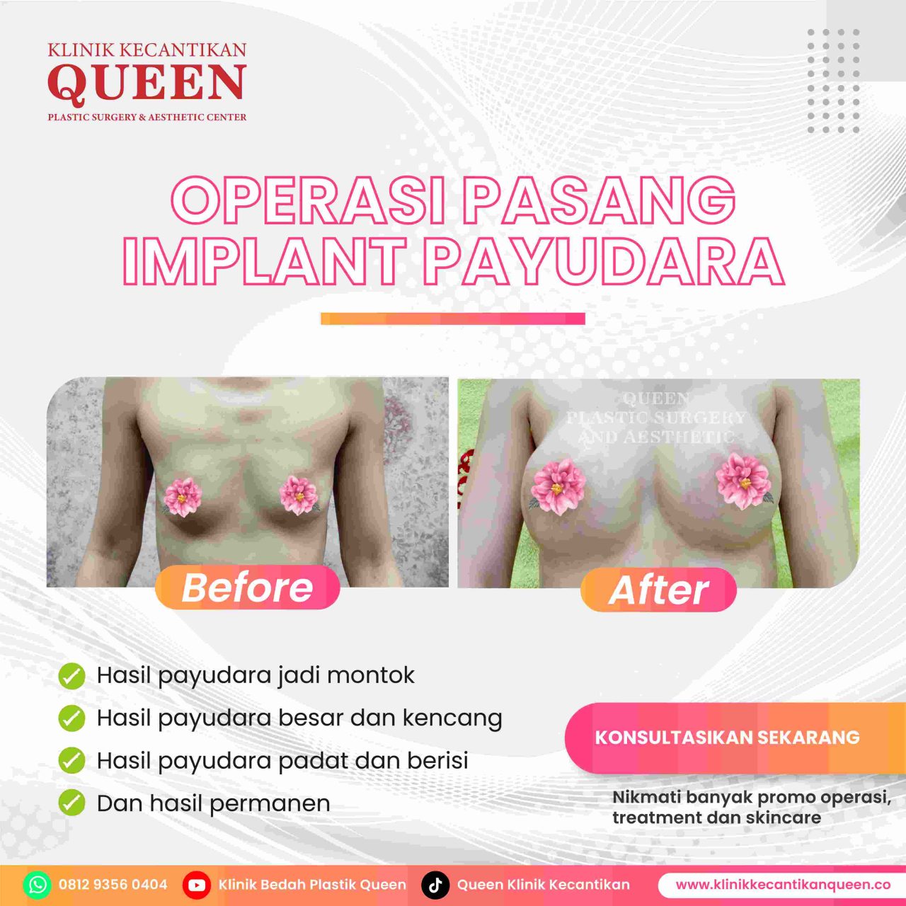Hasil Breast Implant Queen Plastic Surgery, foto 74