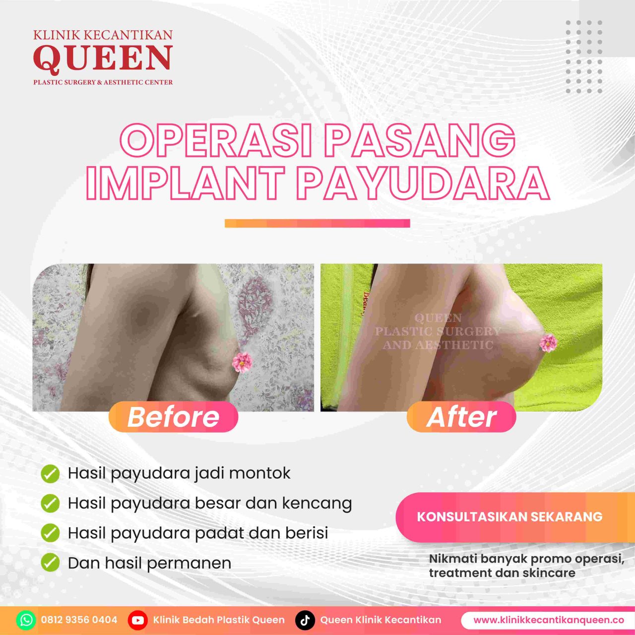 Hasil Breast Implant Queen Plastic Surgery, foto 73