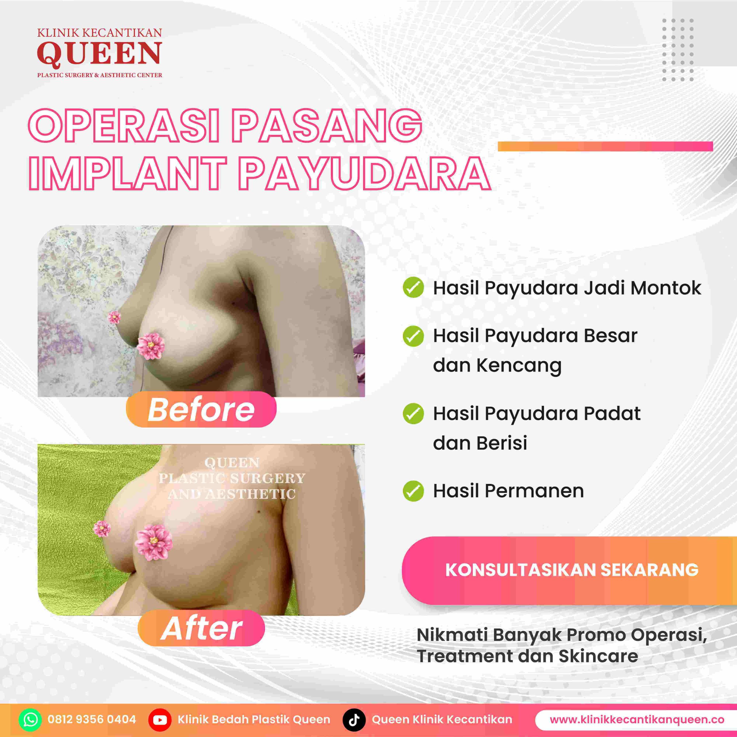 Ingin Payudara Lebih Besar? Revisi Augmentasi Payudara yang Tepat