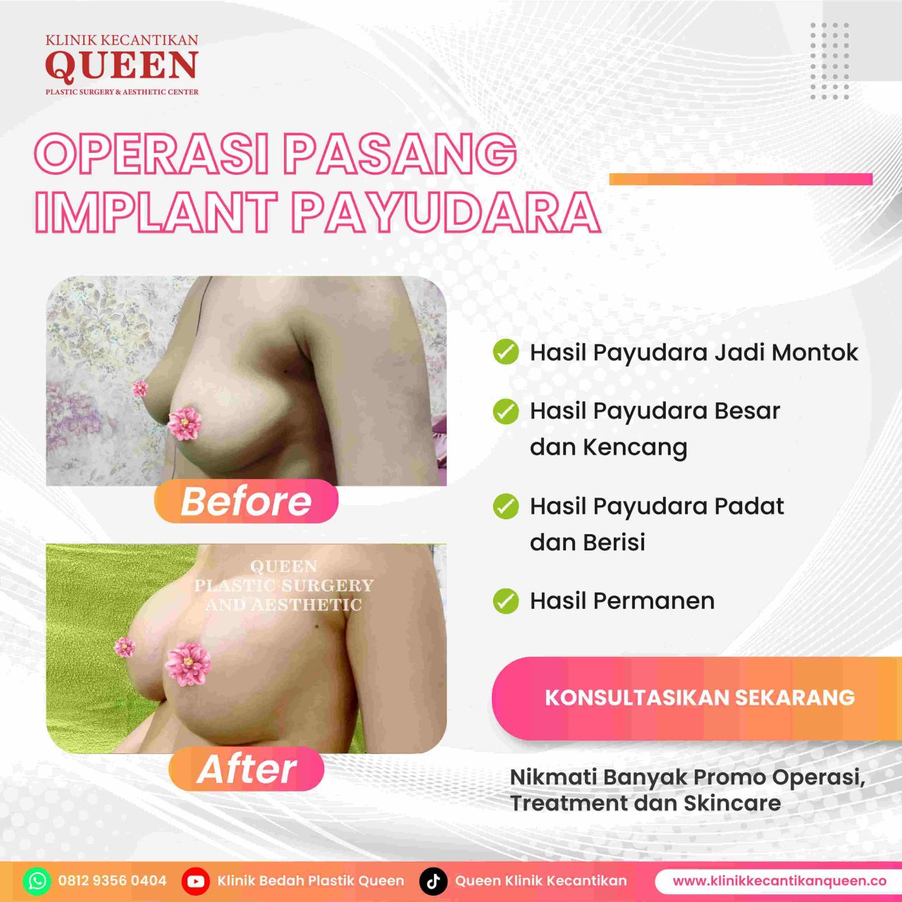 Hasil Breast Implant Queen Plastic Surgery, foto 71