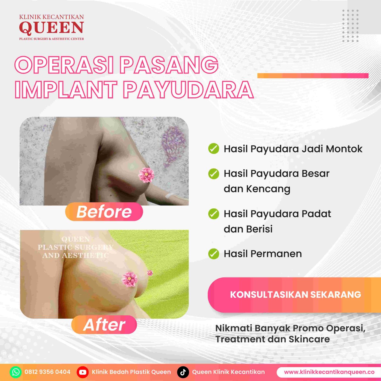 Hasil Breast Implant Queen Plastic Surgery, foto 96
