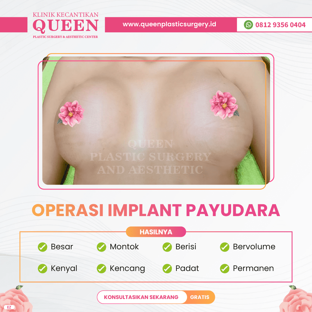 Hasil Breast Implant Queen Plastic Surgery, foto 87