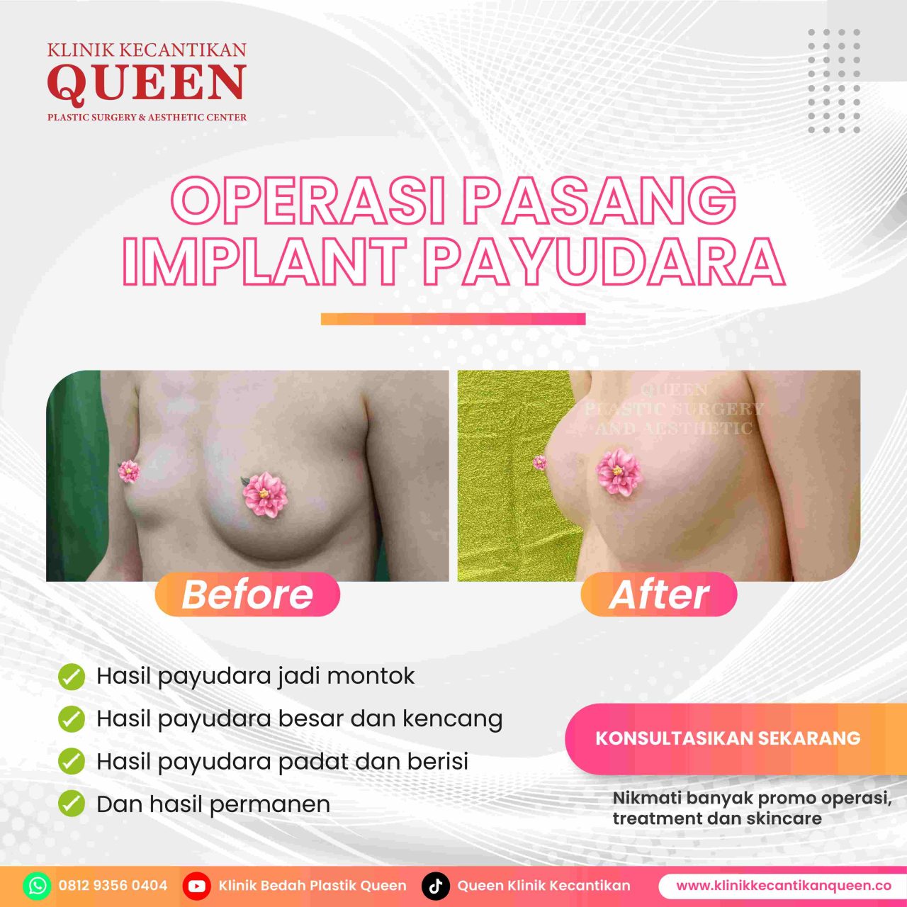 Hasil Breast Implant Queen Plastic Surgery, foto 86