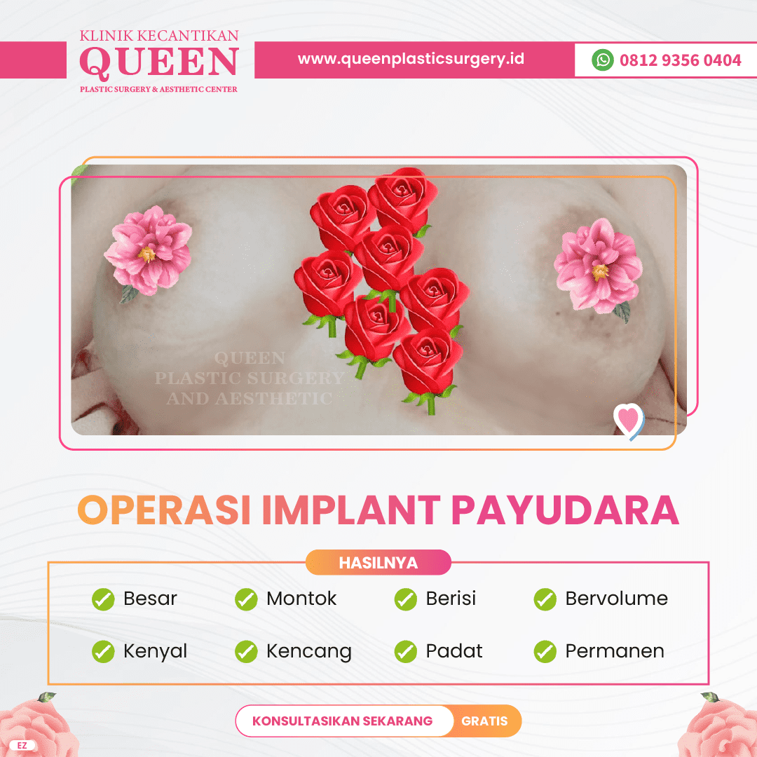 Hasil Breast Implant Queen Plastic Surgery, foto 85