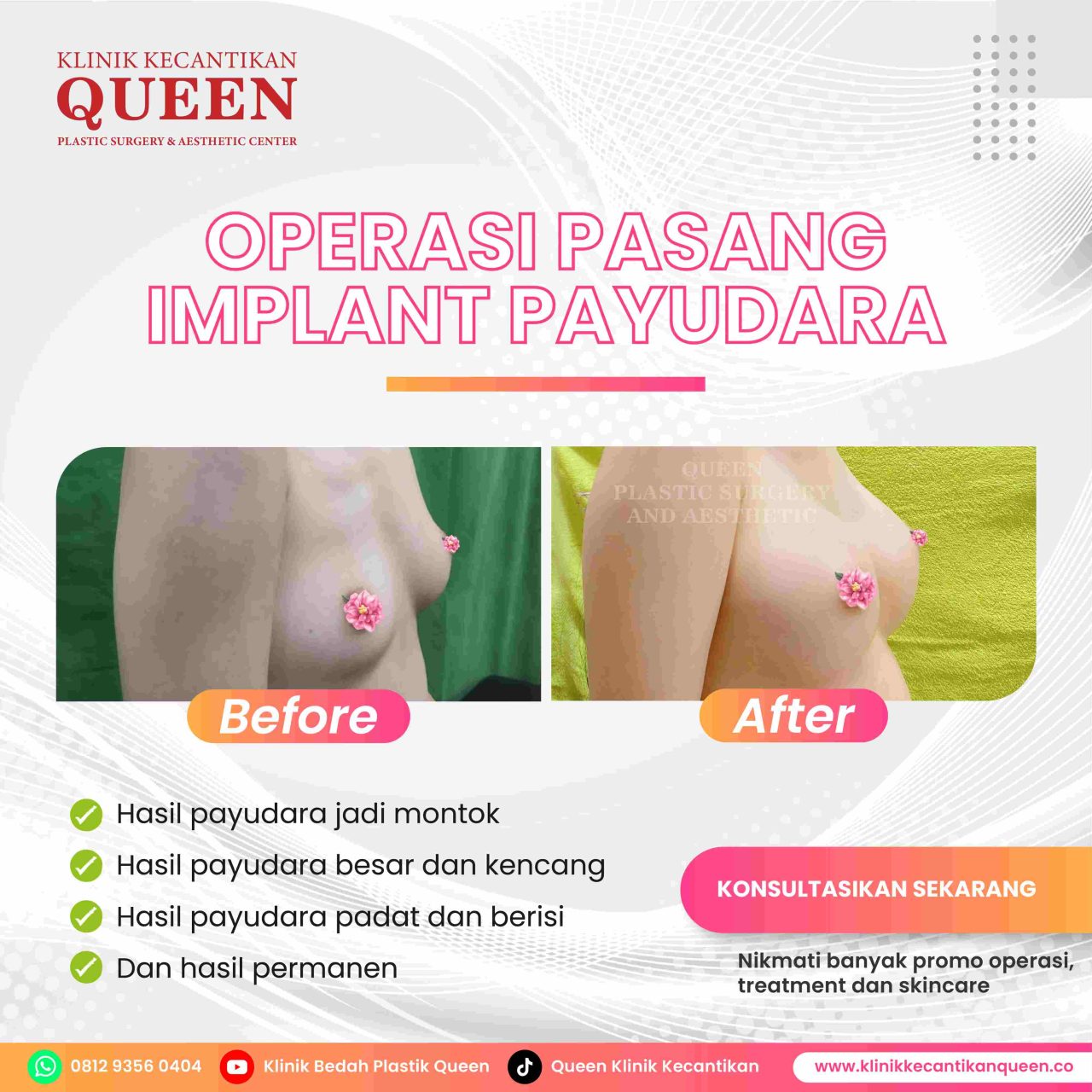 Hasil Breast Implant Queen Plastic Surgery, foto 63