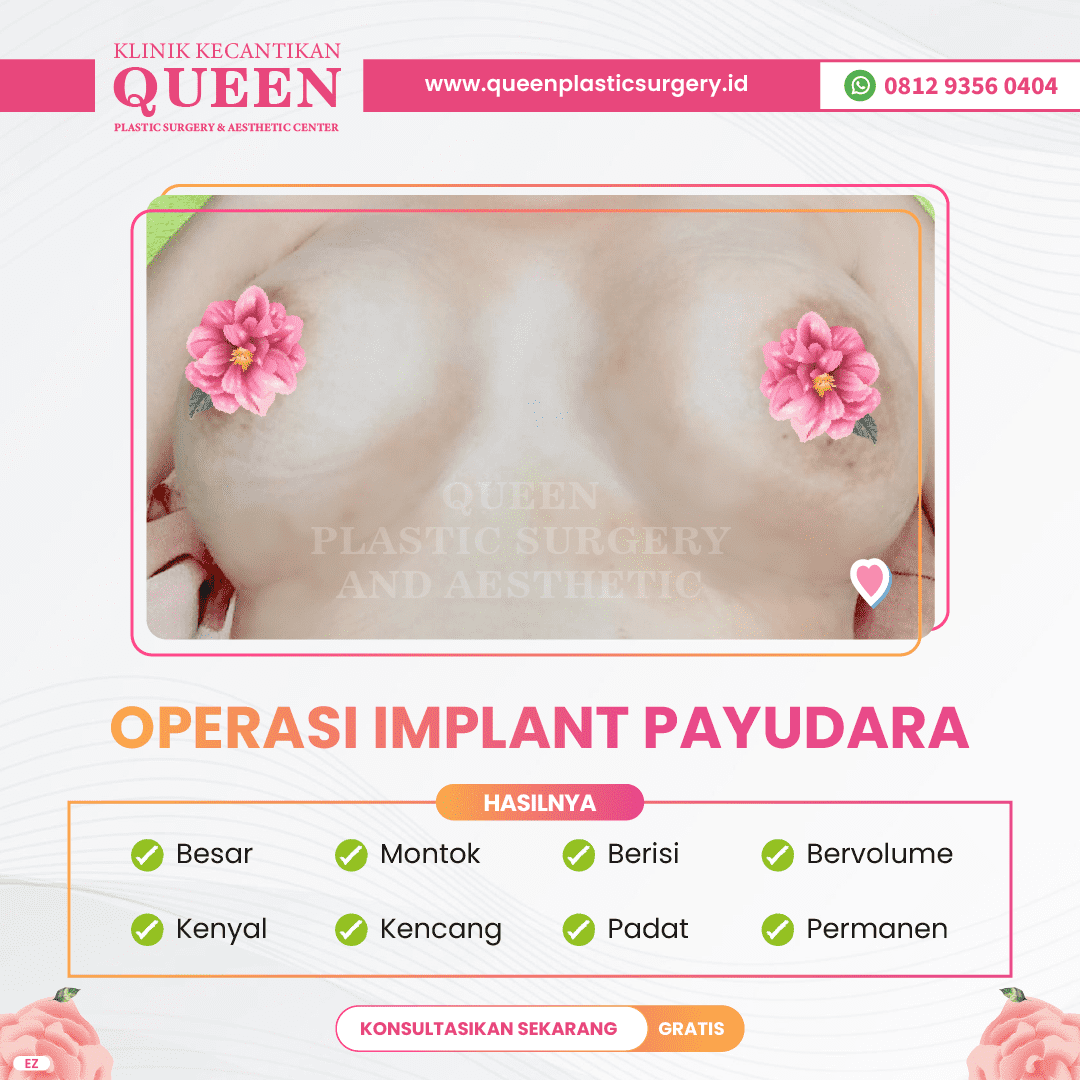 Hasil Breast Implant Queen Plastic Surgery, foto 65