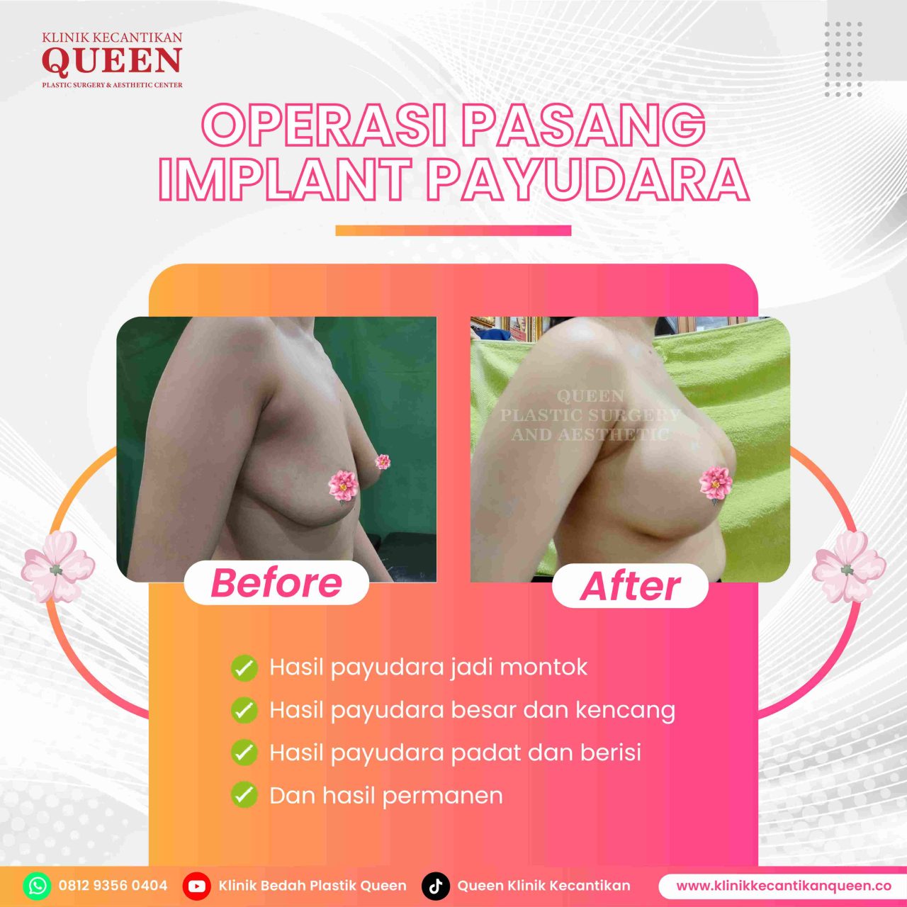 Hasil Breast Implant Queen Plastic Surgery, foto 66