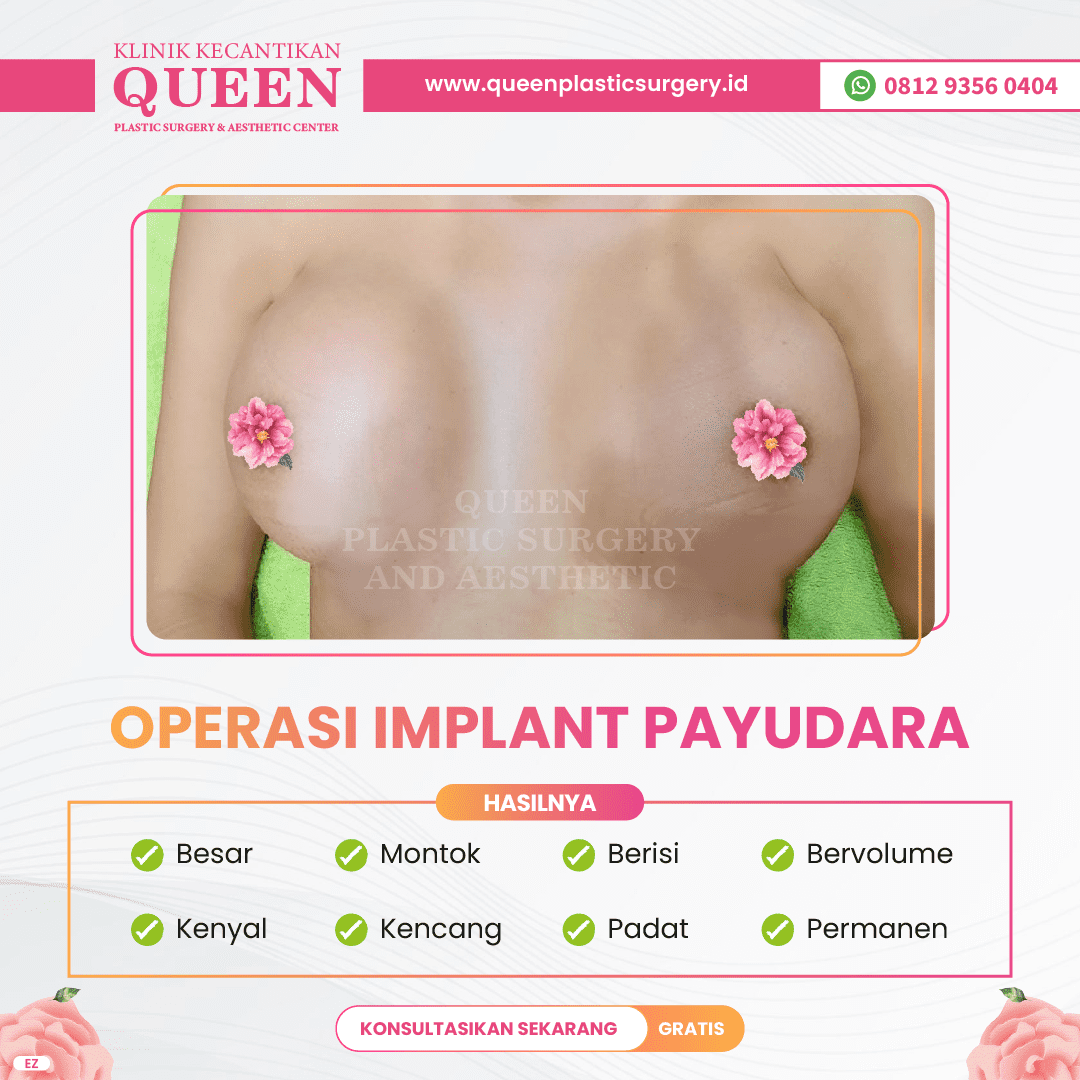 Hasil Breast Implant Queen Plastic Surgery, foto 67