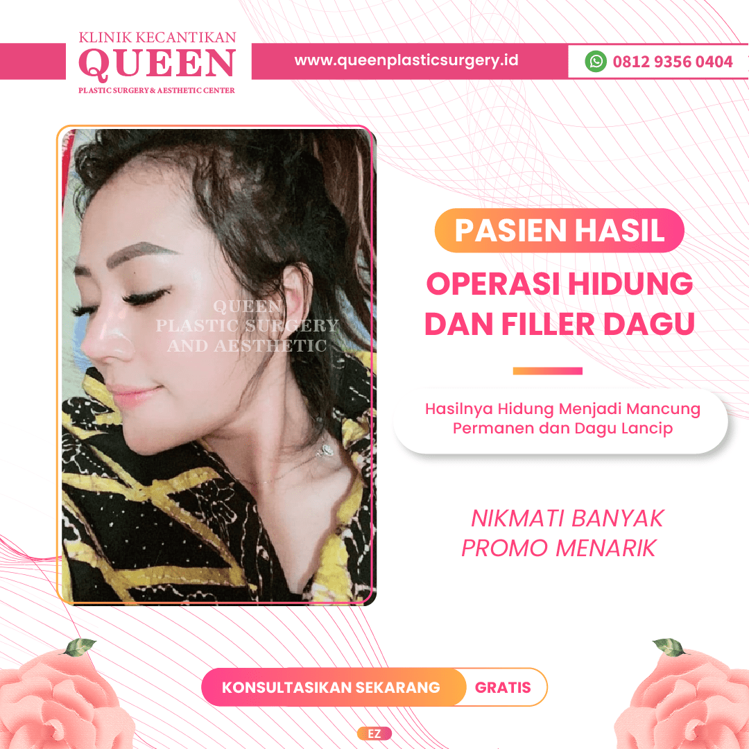 Hasil Rhinoplasty Queen Plastic Surgery, foto 19