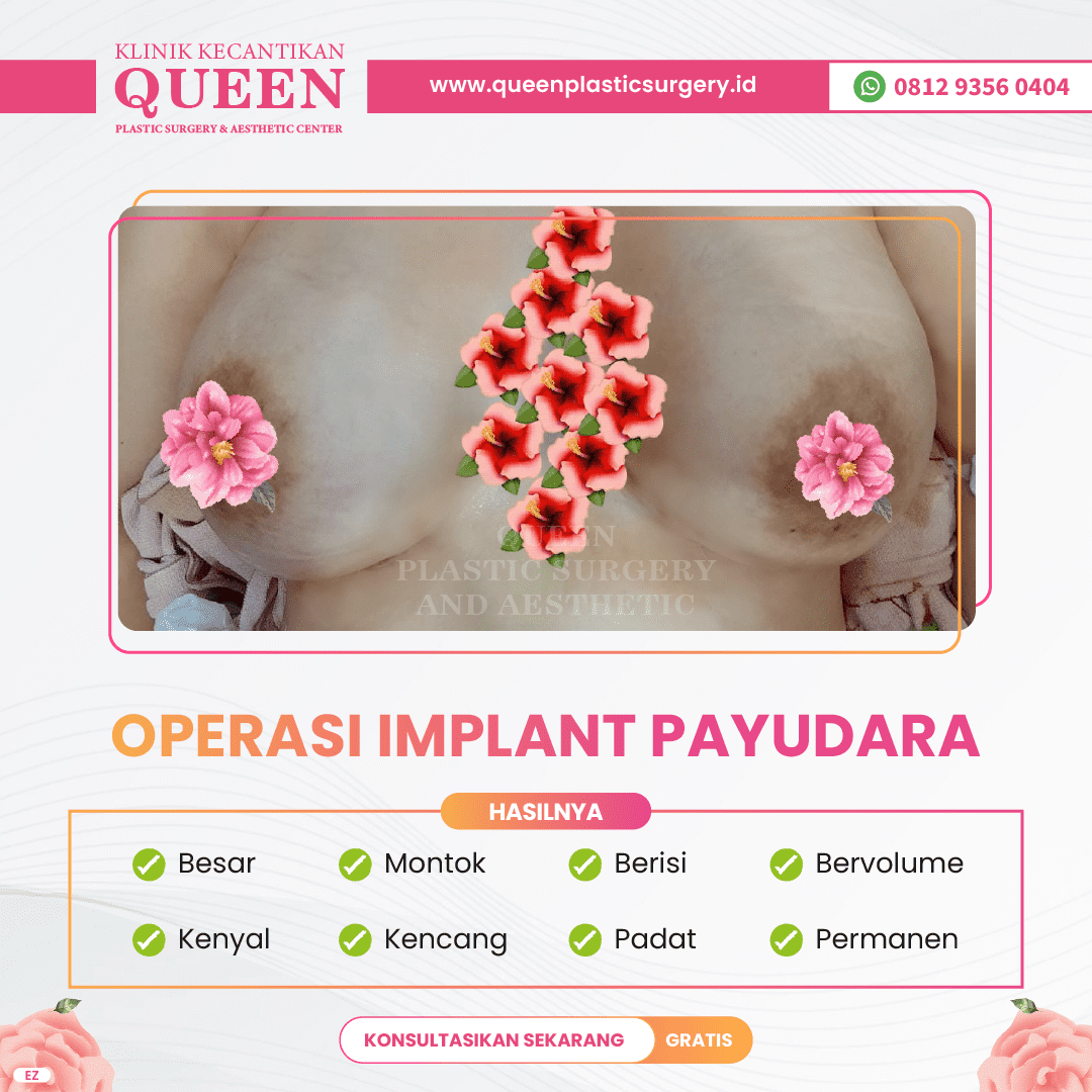 Hasil Breast Implant Queen Plastic Surgery, foto 59
