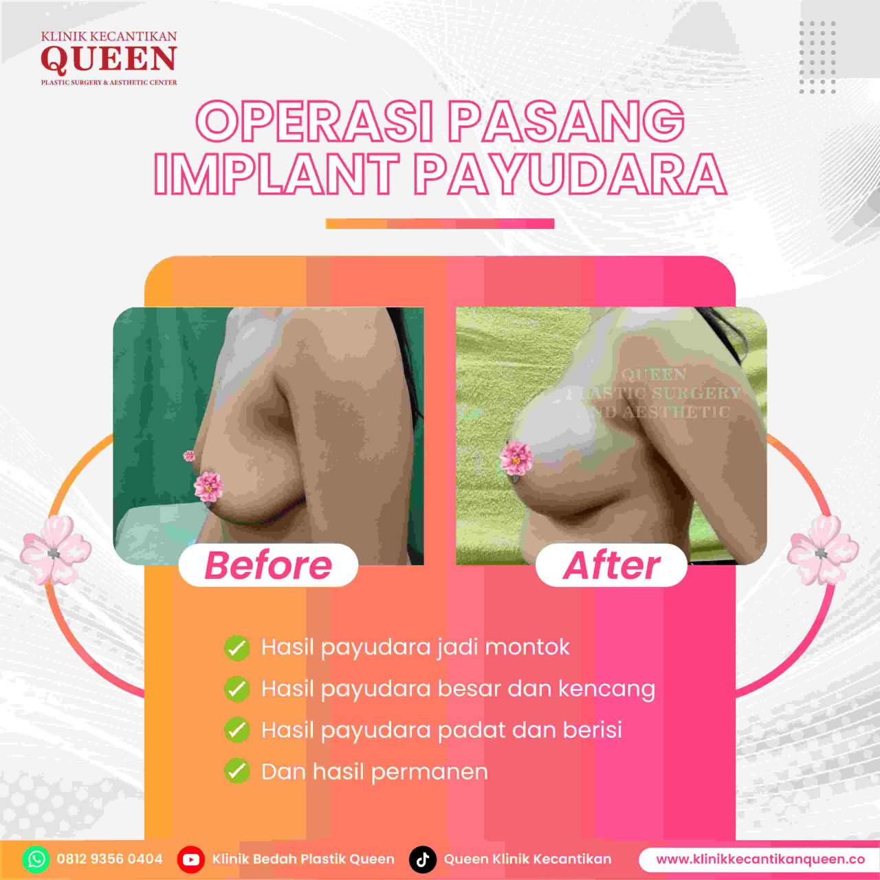 Hasil Breast Implant Queen Plastic Surgery, foto 58