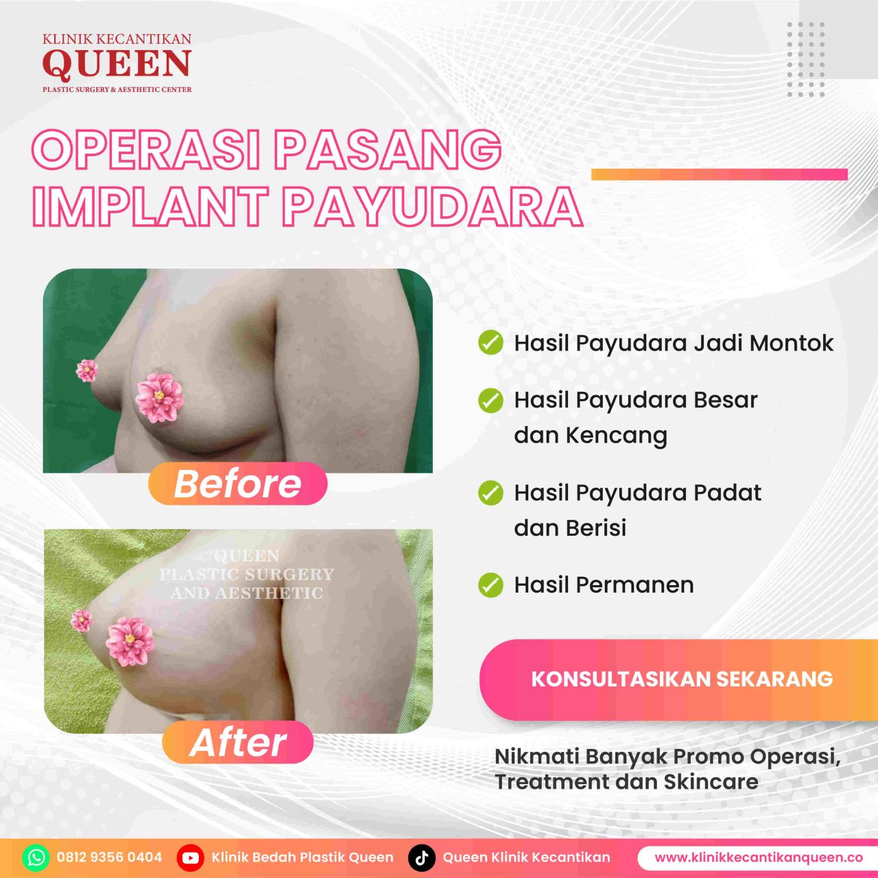 Hasil Breast Implant Queen Plastic Surgery, foto 56