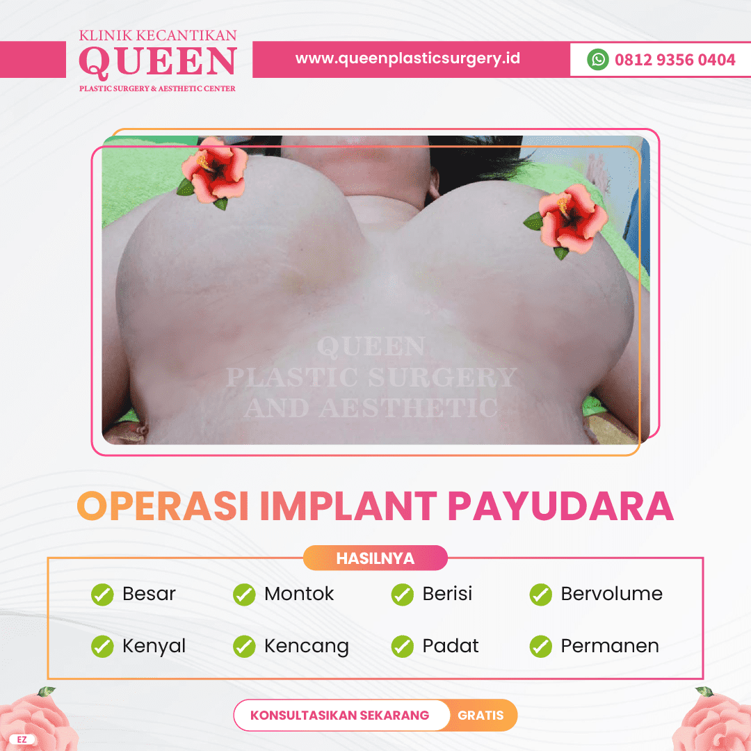 Implan Payudara Bermasalah? Kapsulektomi En Bloc Boleh Jadi Jawabannya!