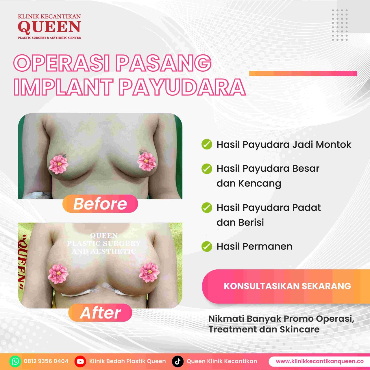 Hasil Breast Implant Queen Plastic Surgery, foto 54