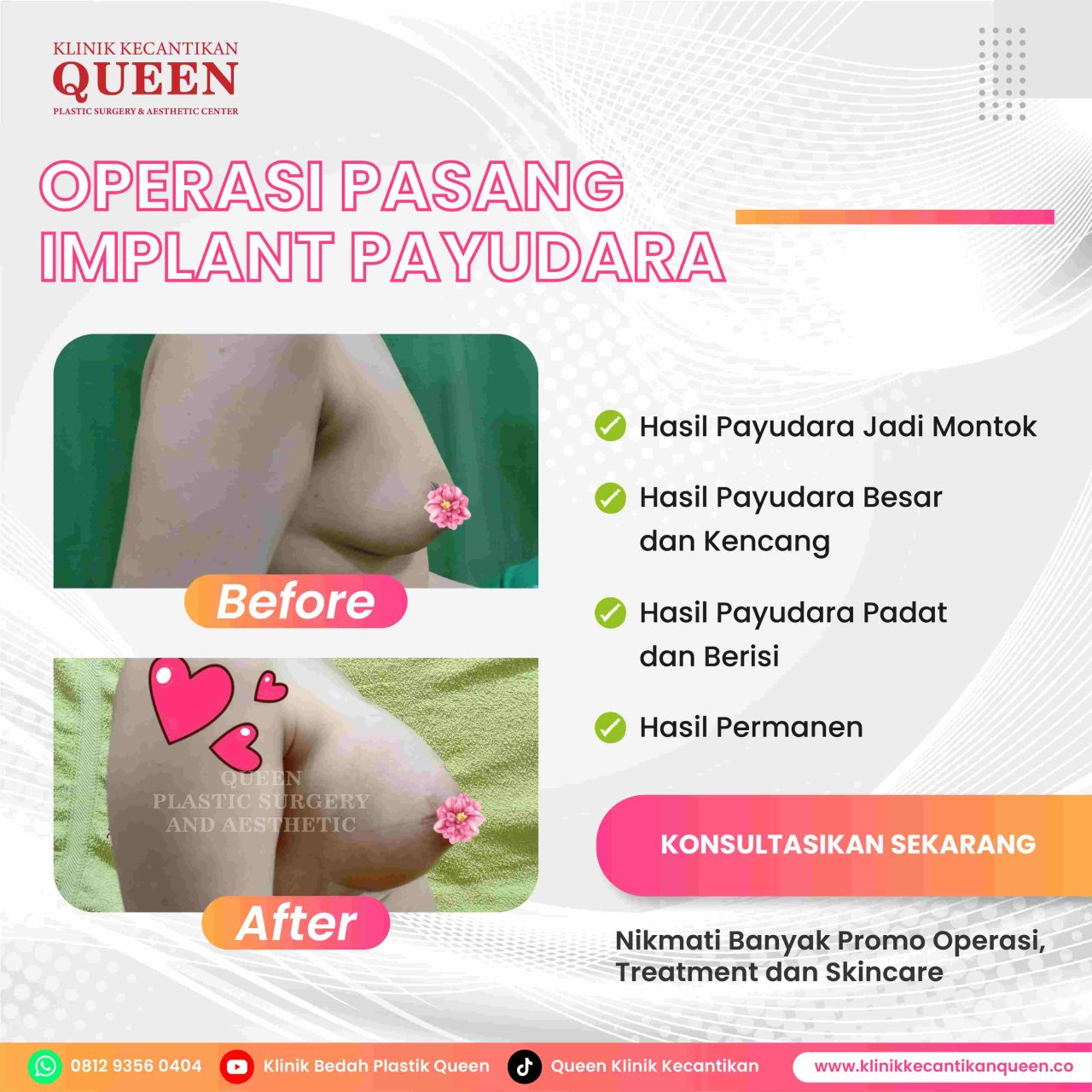 Hasil Breast Implant Queen Plastic Surgery, foto 53