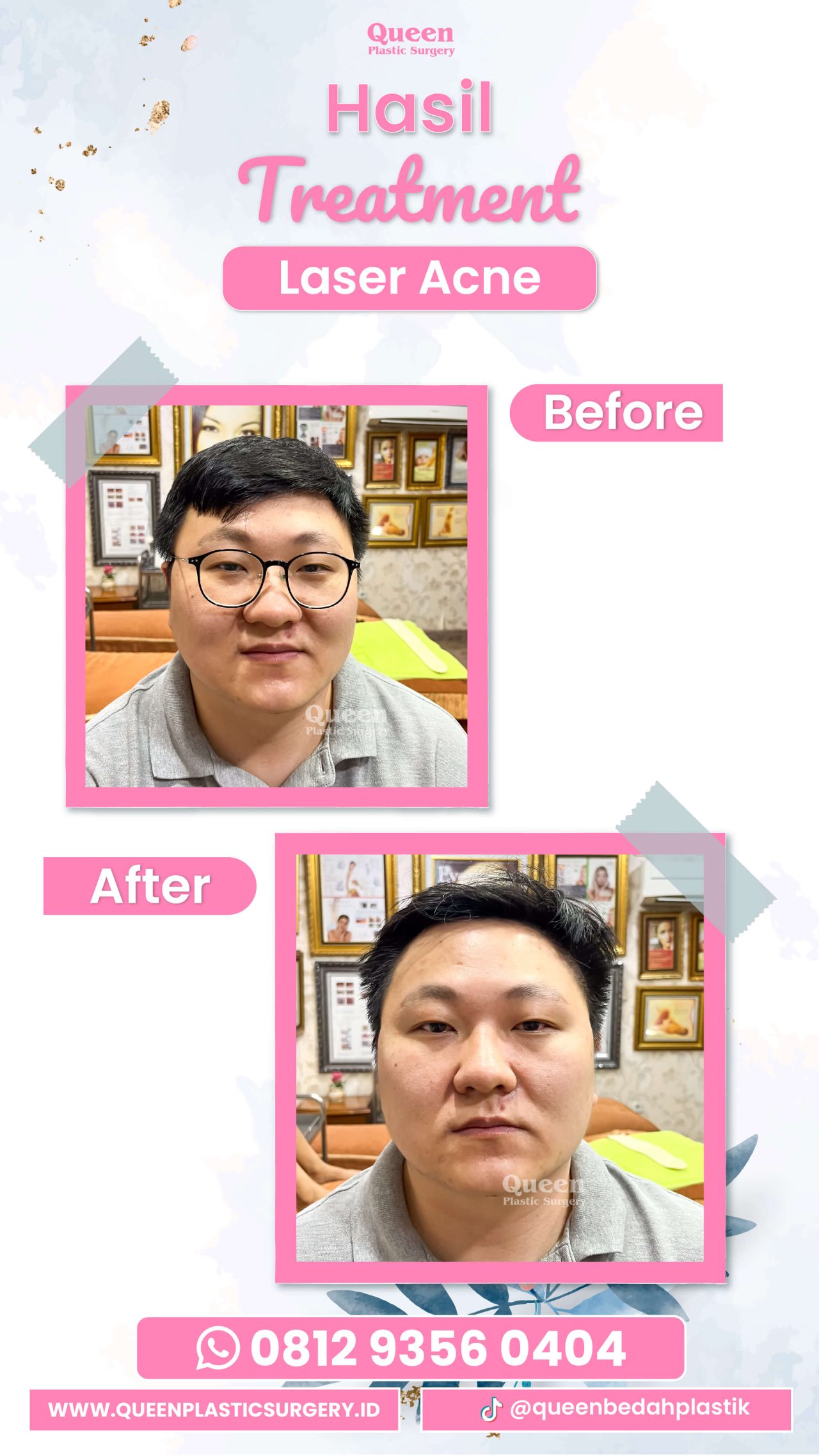 Hasil Rhinoplasty Queen Plastic Surgery, foto 20