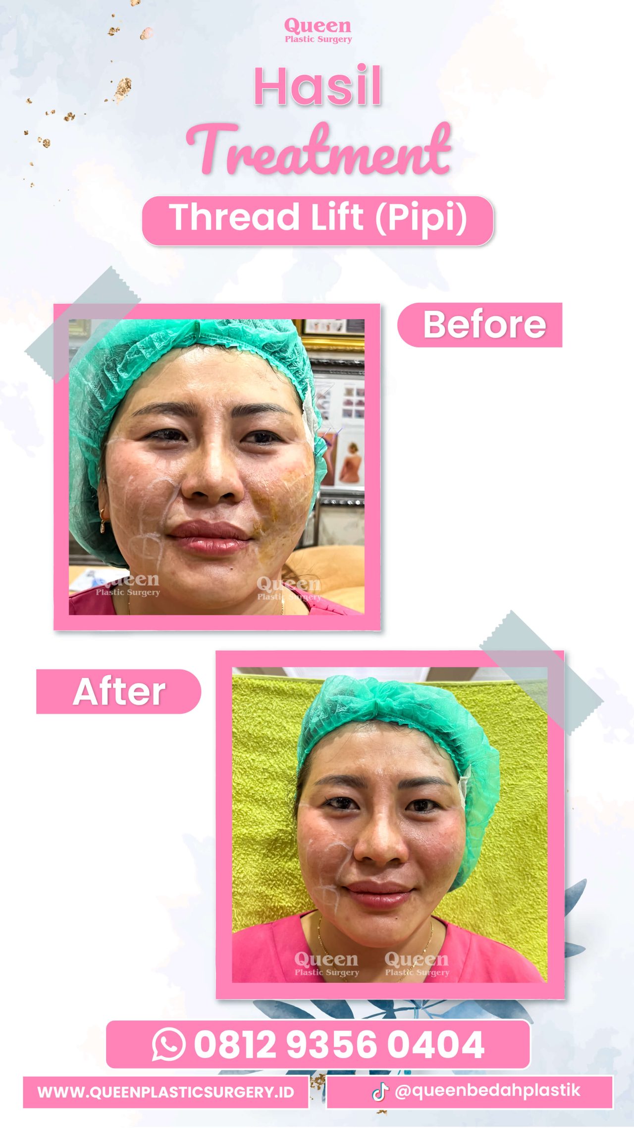Hasil Rhinoplasty Queen Plastic Surgery, foto 23