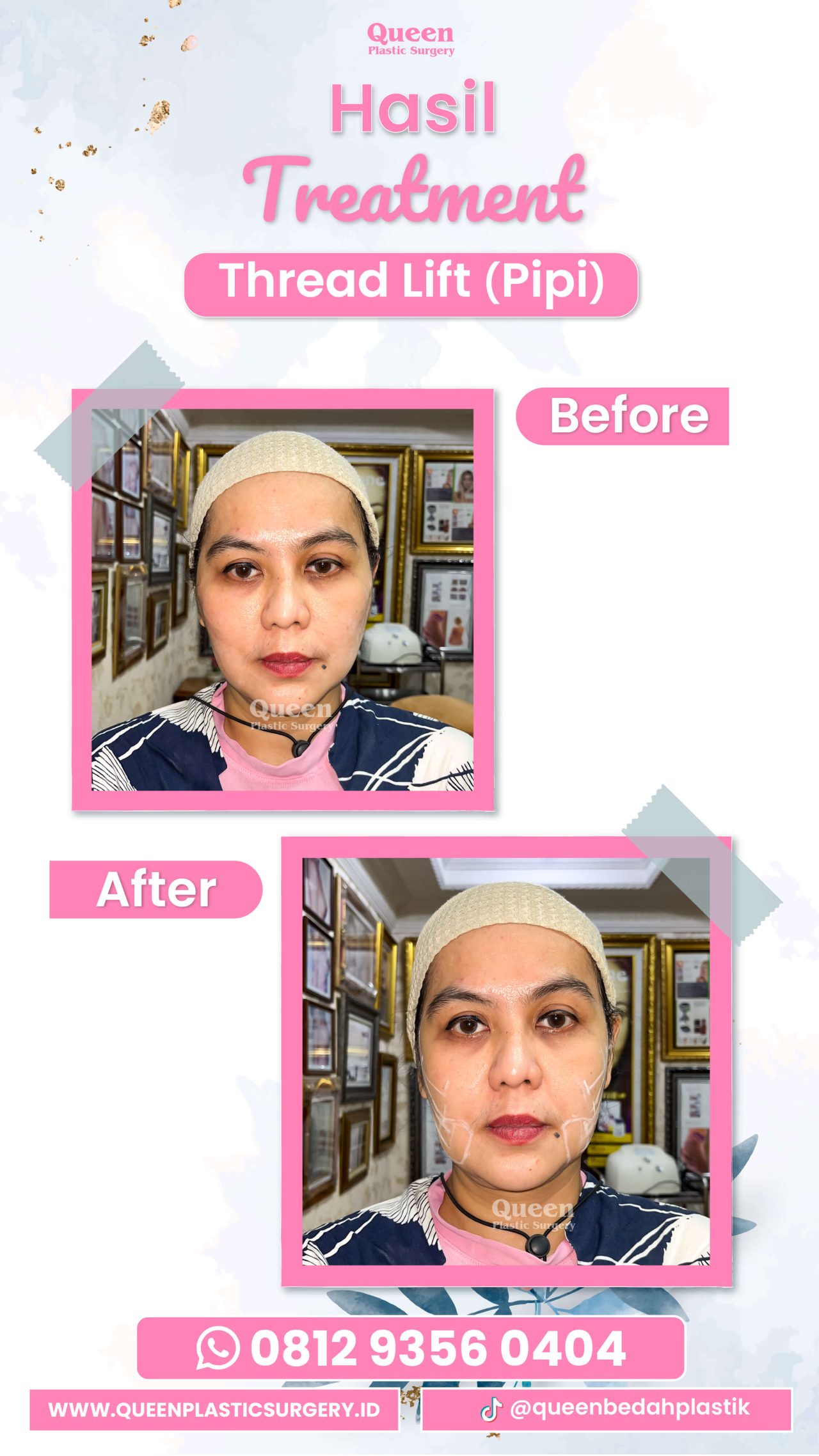 Hasil Rhinoplasty Queen Plastic Surgery, foto 22