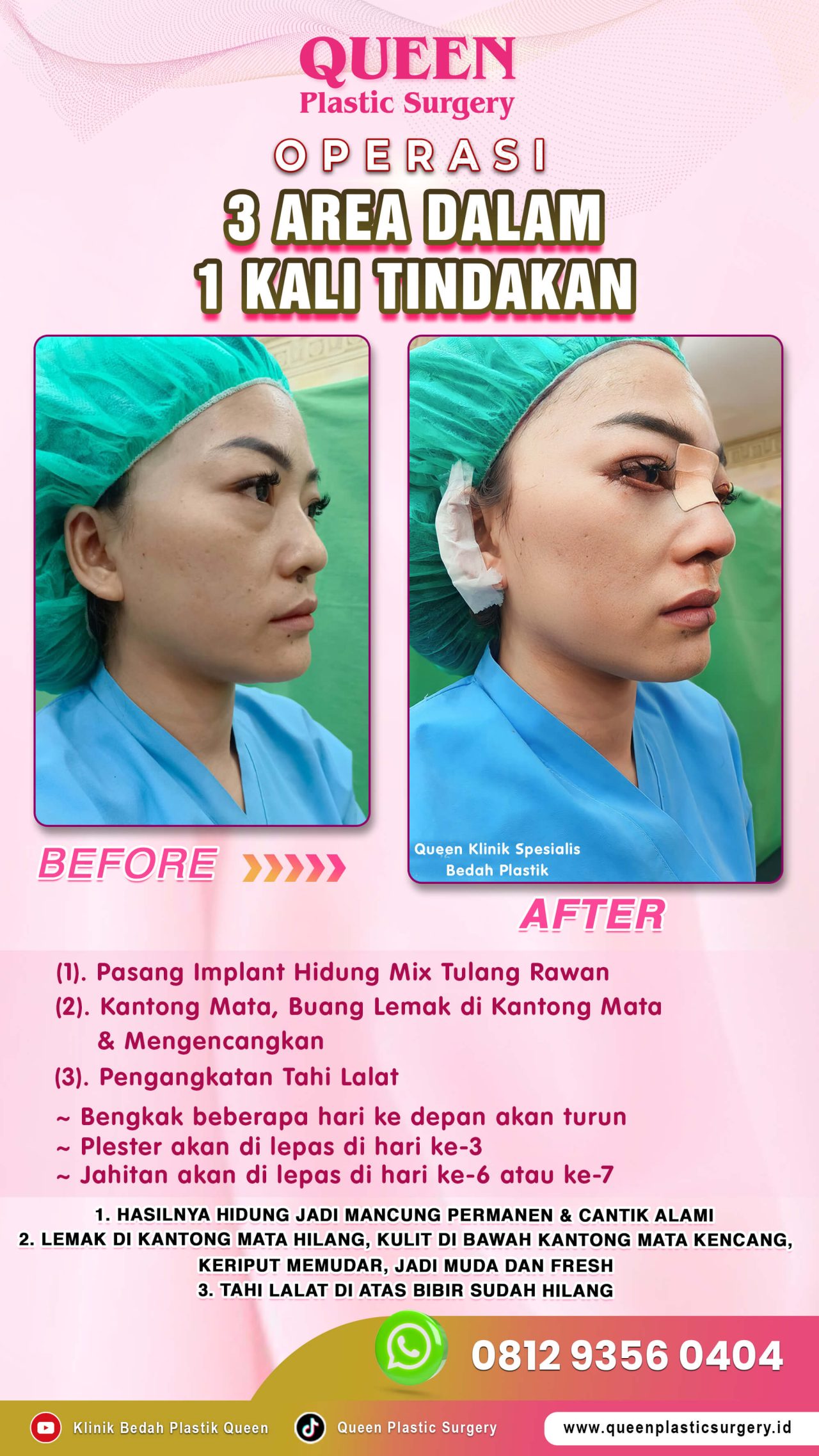 Hasil Rhinoplasty Queen Plastic Surgery, foto 21