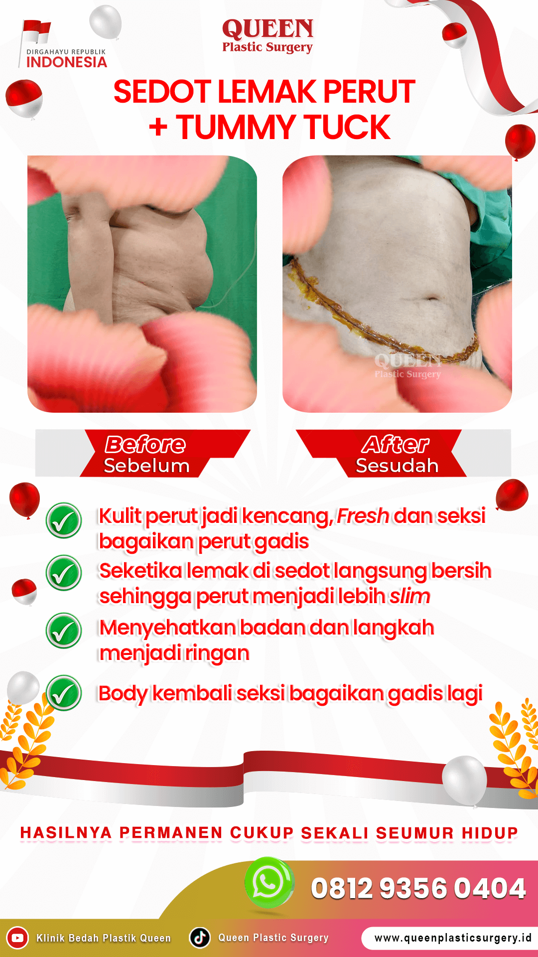 Sedot-Lemak-+-Tummy-Tuck-IGS-02 (3) (1)
