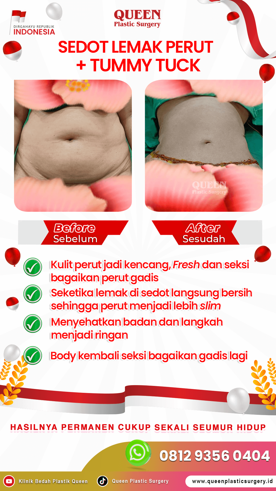 Sedot-Lemak-+-Tummy-Tuck-IGS-03 (1)