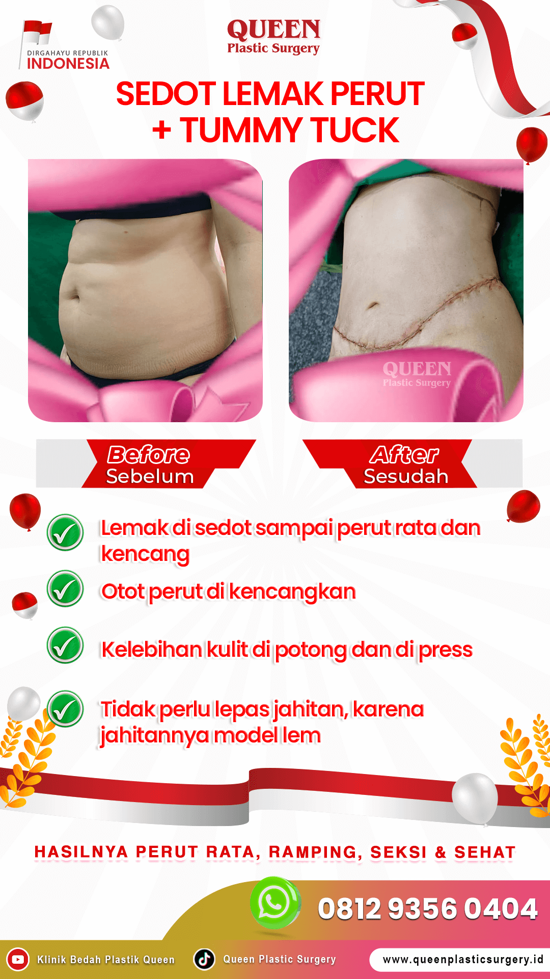 "Tummy Tuck (Abdominoplasty): Memilih Antara Drain atau Tanpa Drain, Mana yang Terbaik untuk Anda?" "Perbandingan Tummy Tuck: Drain vs Tanpa Drain, Pilihan yang Tepat untuk Hasil Optimal" "Tummy Tuck Tanpa Drain: Keuntungan dan Kerugian Dibandingkan dengan Metode Ber-Drain" "Mengenal Tummy Tuck: Apa yang Perlu Anda Tahu tentang Drain dan Tanpa Drain?" "Tummy Tuck (Abdominoplasty) untuk Semua: Memahami Pilihan Drain vs Tanpa Drain"