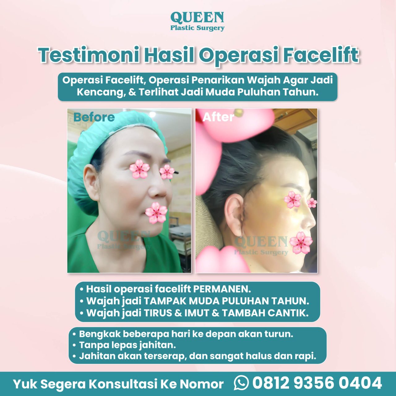Hasil Rhinoplasty Queen Plastic Surgery, foto 24