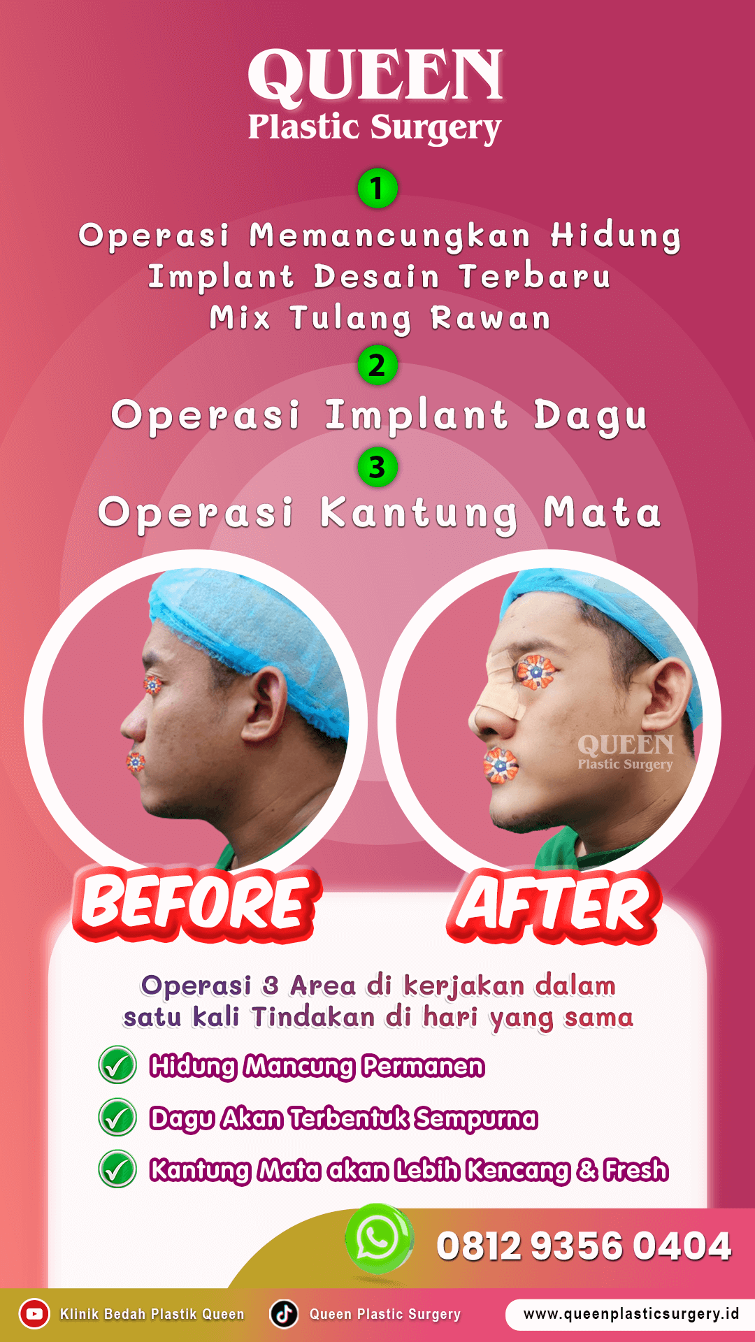 3 Operasi Pria Hidung Dagu & Kantung Mata 01