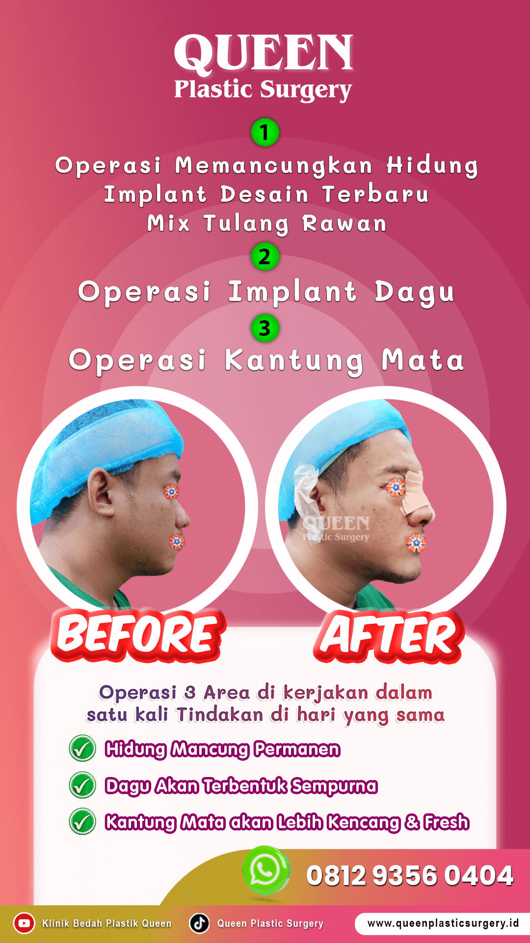 3 Operasi Pria Hidung Dagu & Kantung Mata 02
