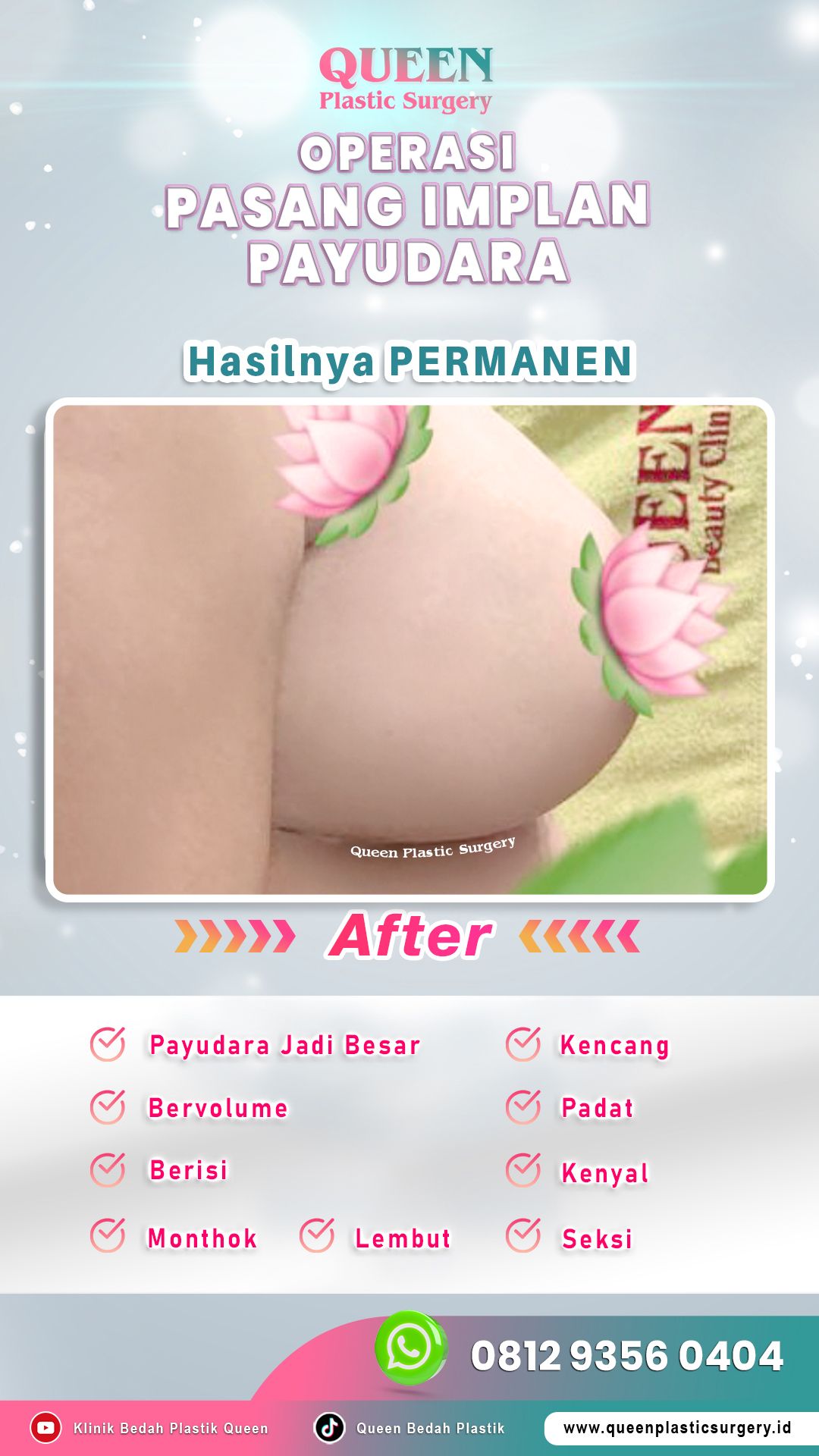 AFTER-Operasi-Pasang-Implan-Payudara-05-fotor-202406031103