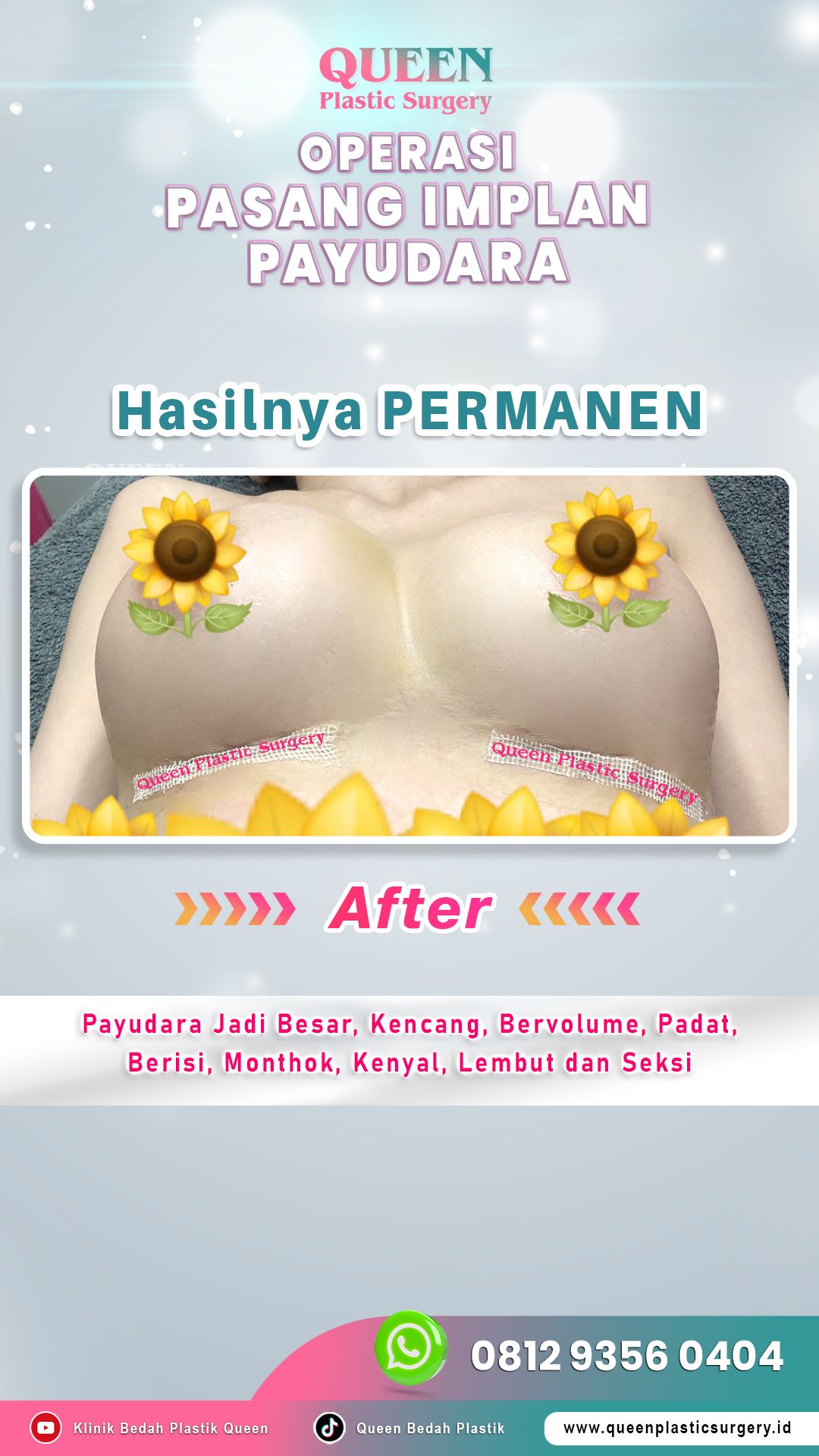 AFTER-Operasi-Pasang-Implan-Payudara-06-fotor-20240603105954