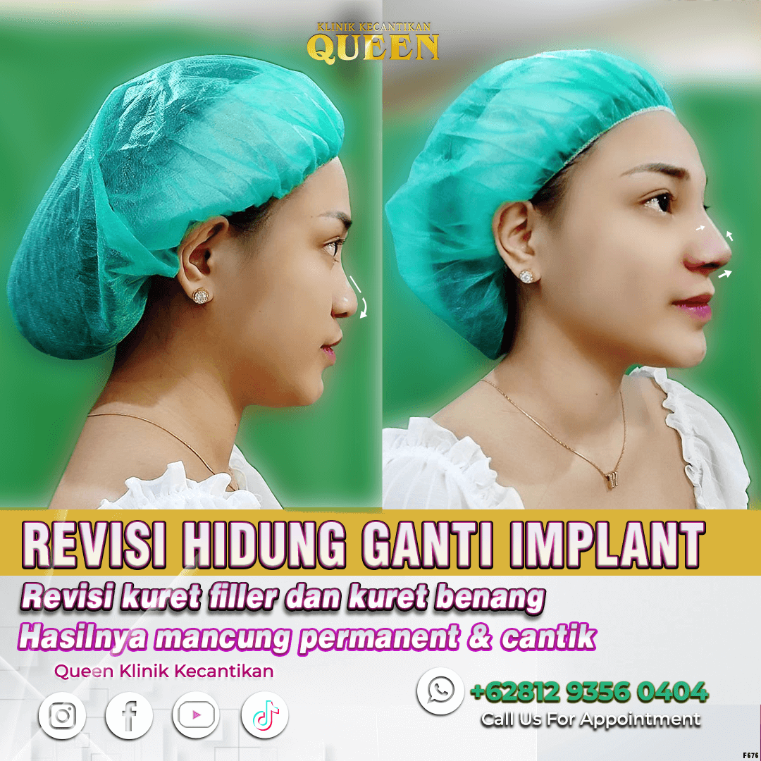 BEFORE & AFTER Revisi Kuret filler & Kuret Benang