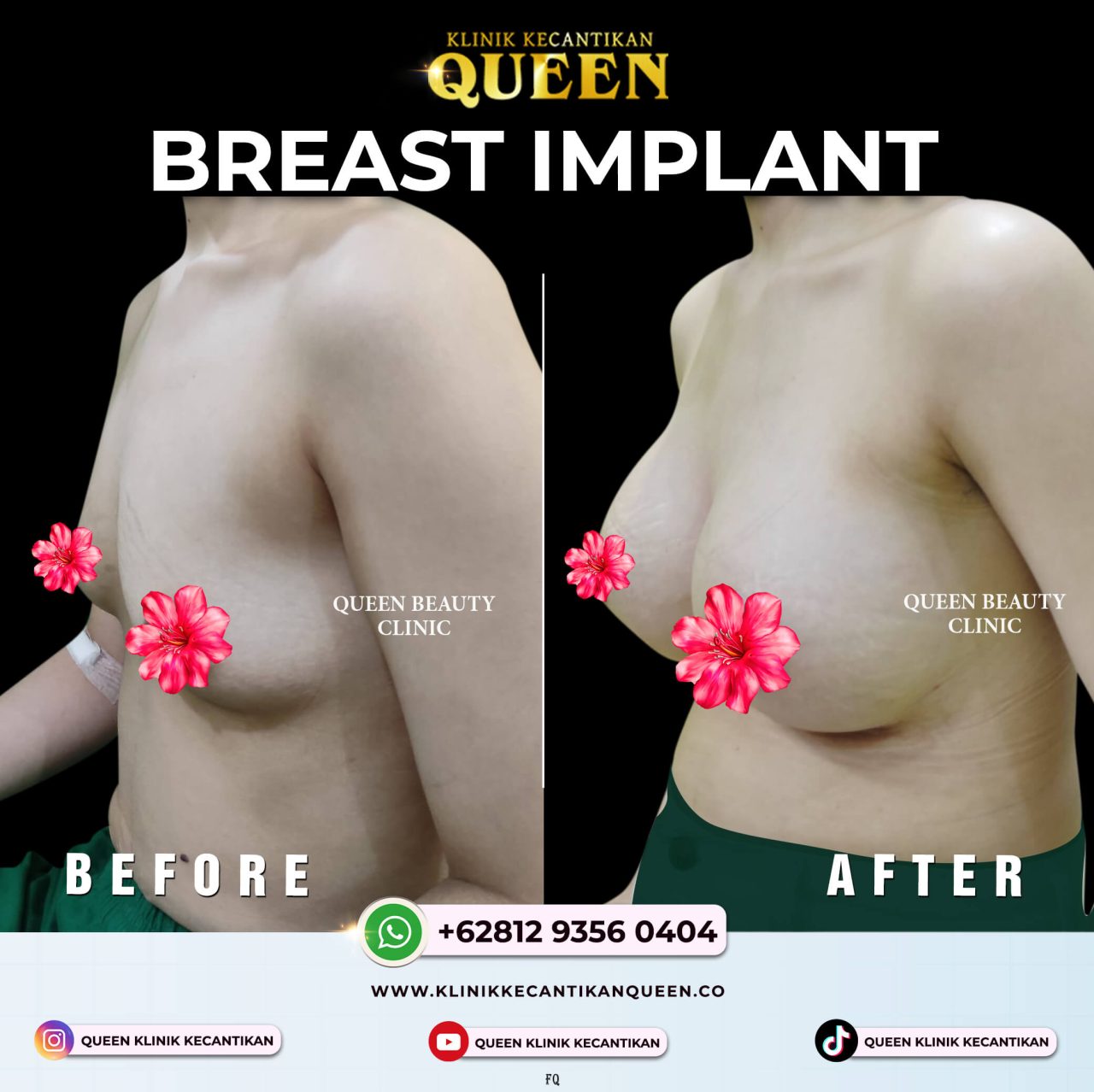 Hematoma Setelah Augmentasi Payudara: Apa yang Harus Anda Ketahui?