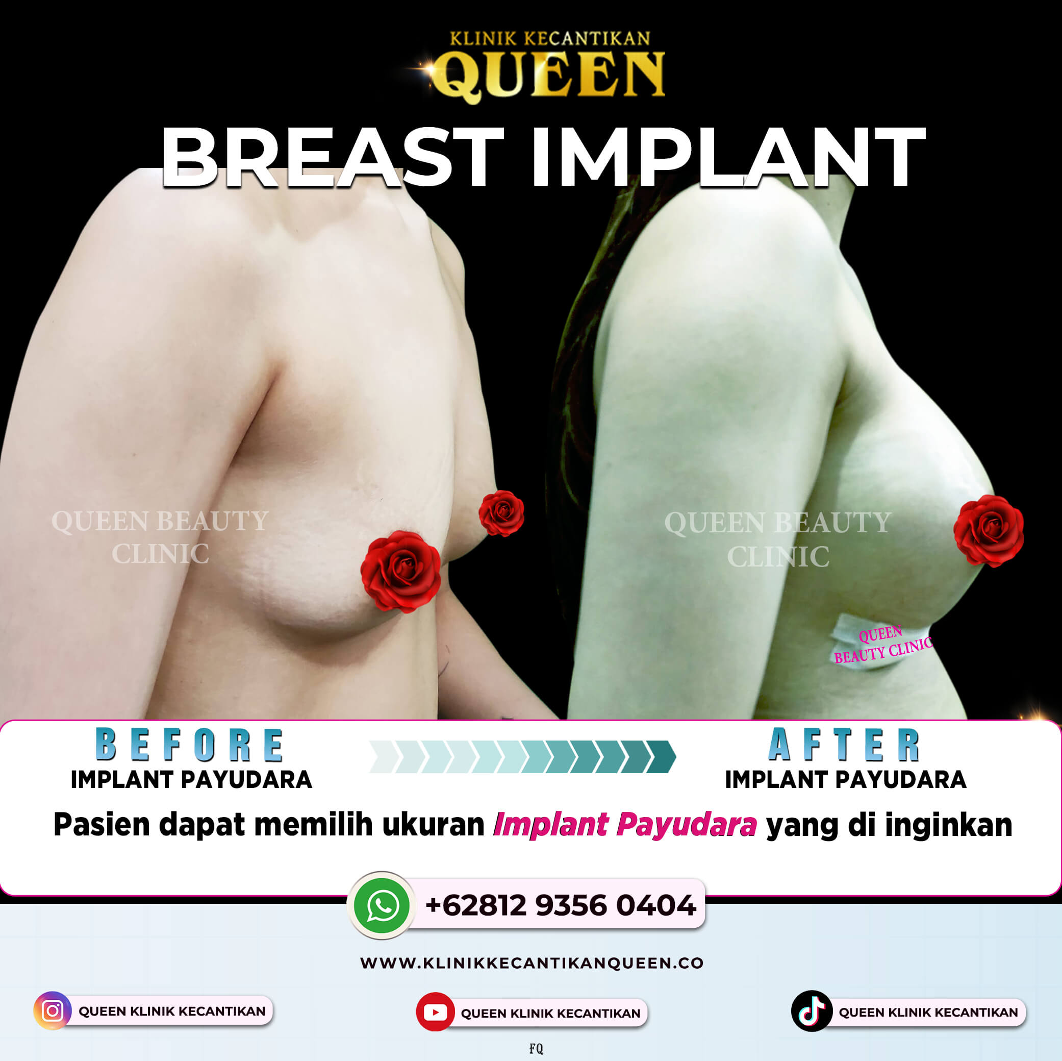 BREAST IMPLANT 2