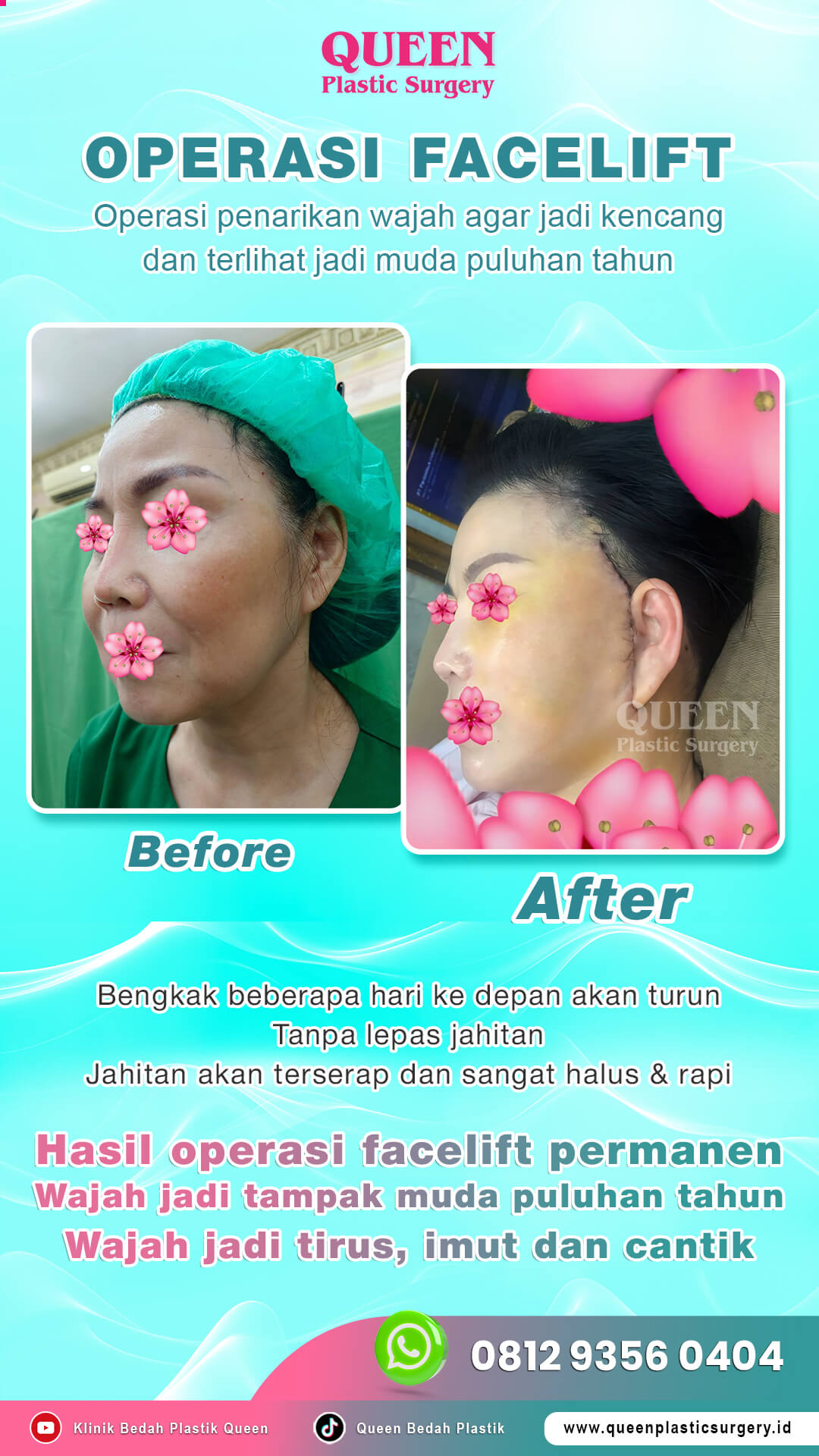 Hasil Rhinoplasty Queen Plastic Surgery, foto 1