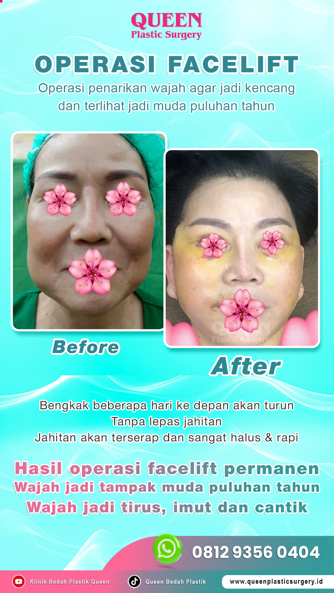 Hasil Rhinoplasty Queen Plastic Surgery, foto 99