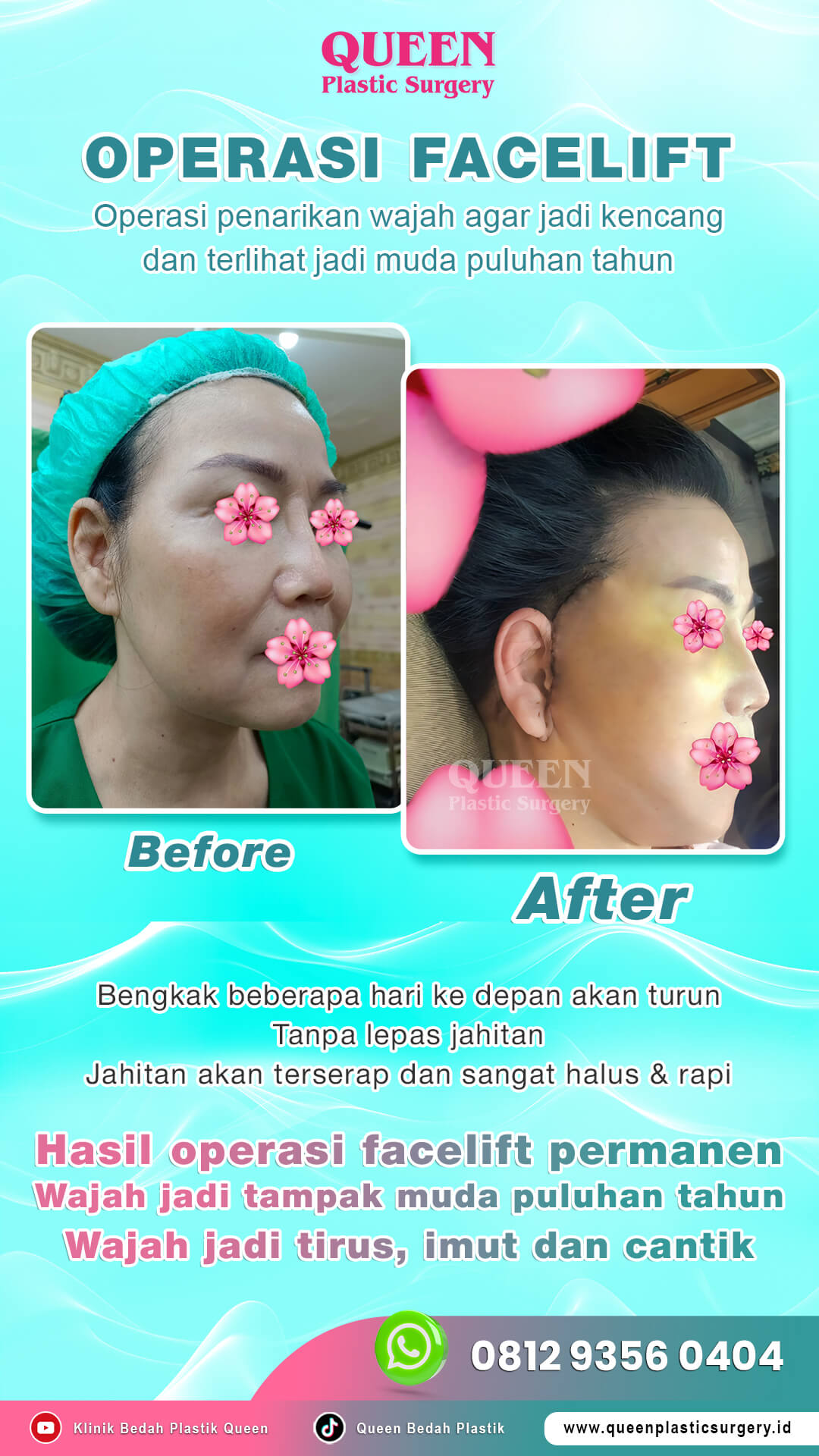 Hasil Rhinoplasty Queen Plastic Surgery, foto 3