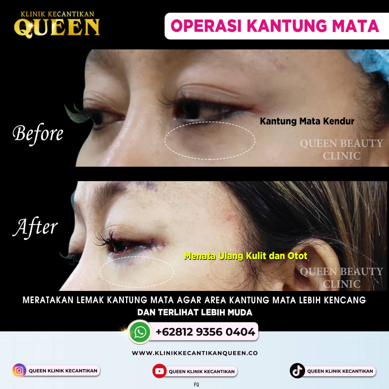 Before & After KANTUNG MATA