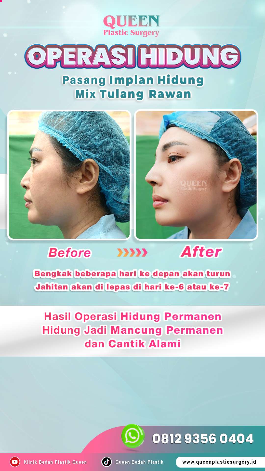 Before-After-OP-Hidung-Mancung-Permanen-dan-Cantik-Alami-001-
